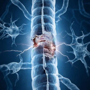 Синдром Гийена-Барре: как иммунитет может подвести